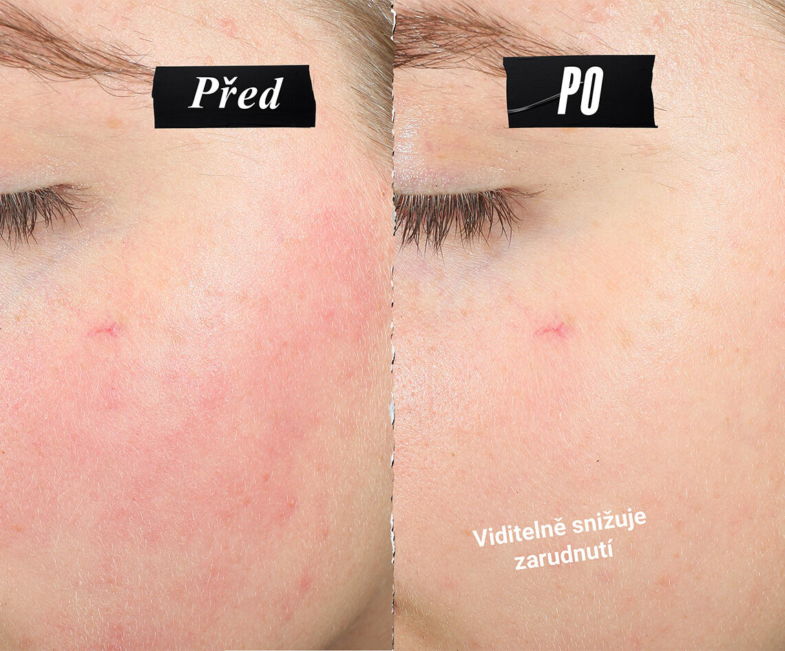 Srovnani ukazujici zmirněni začervenani pleti. Text zni: Viditelně redukuje začervenani.