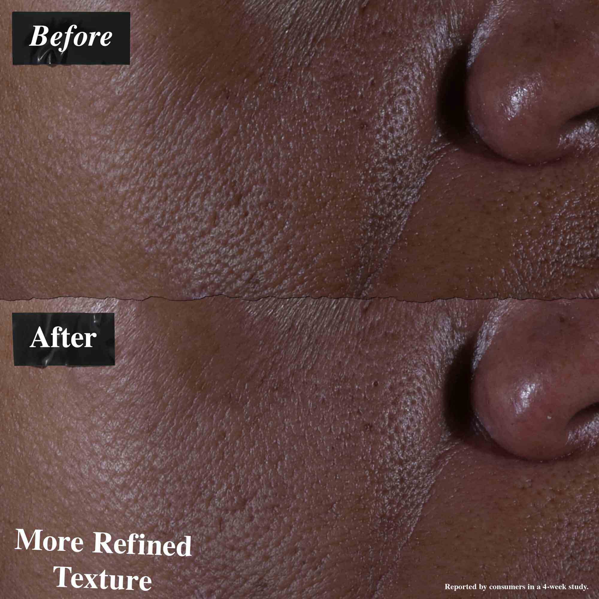 Srovnani před a po ukazujici pleť ošetřenou Ultra Pure 9.8% Glycolic Acid Serum. Obrazek „před“ ukazuje nerovnoměrnou texturu, zatimco obrazek „po“ ukazuje jemnějši texturu.