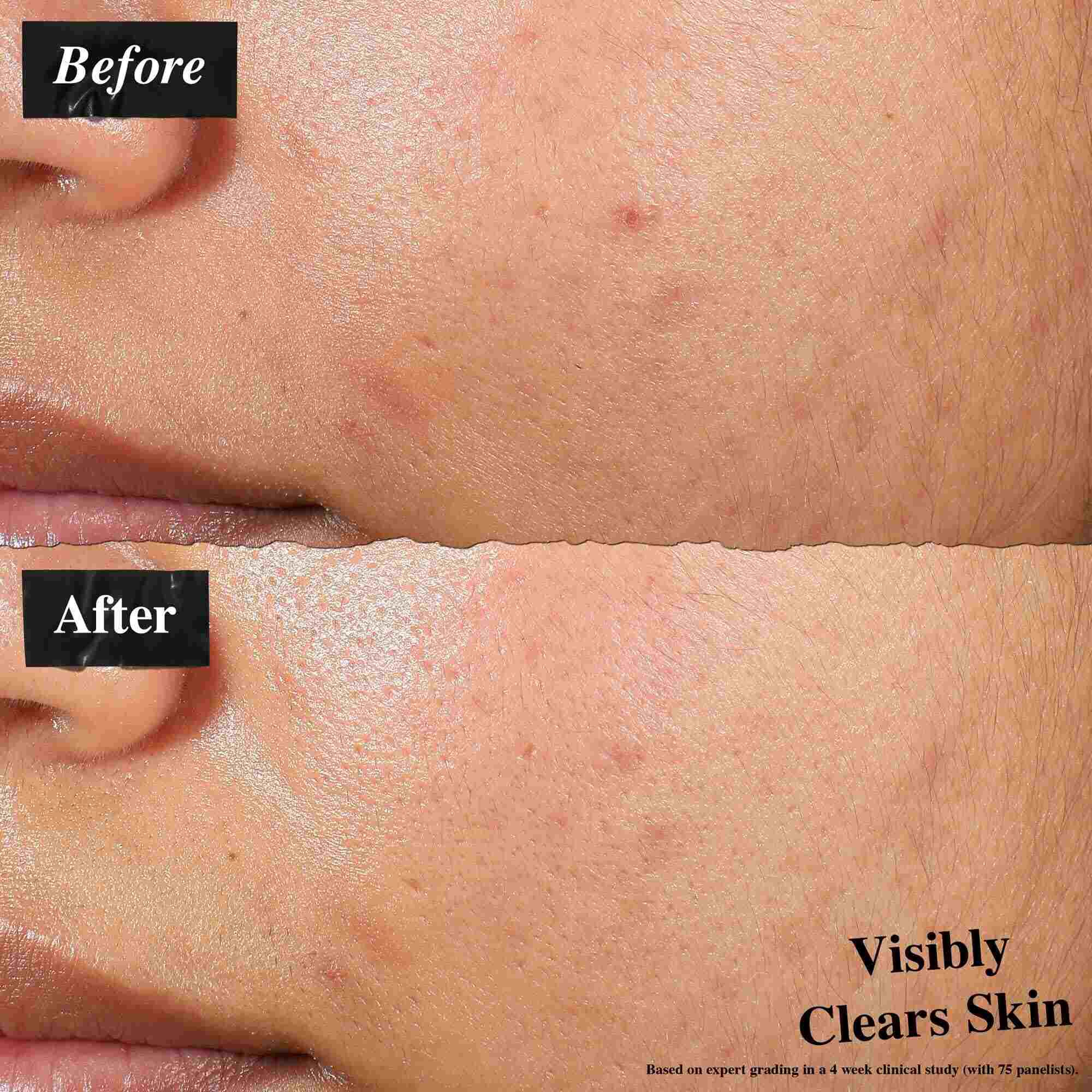 Srovnani před a po ukazujici pleť ošetřenou Expertly Clear Blemish-Treating & Preventing Lotion. Obrazek „před“ ukazuje nedokonalosti a nerovnoměrnou texturu pleti, zatimco obrazek „po“ ukazuje viditelně čistši pleť.