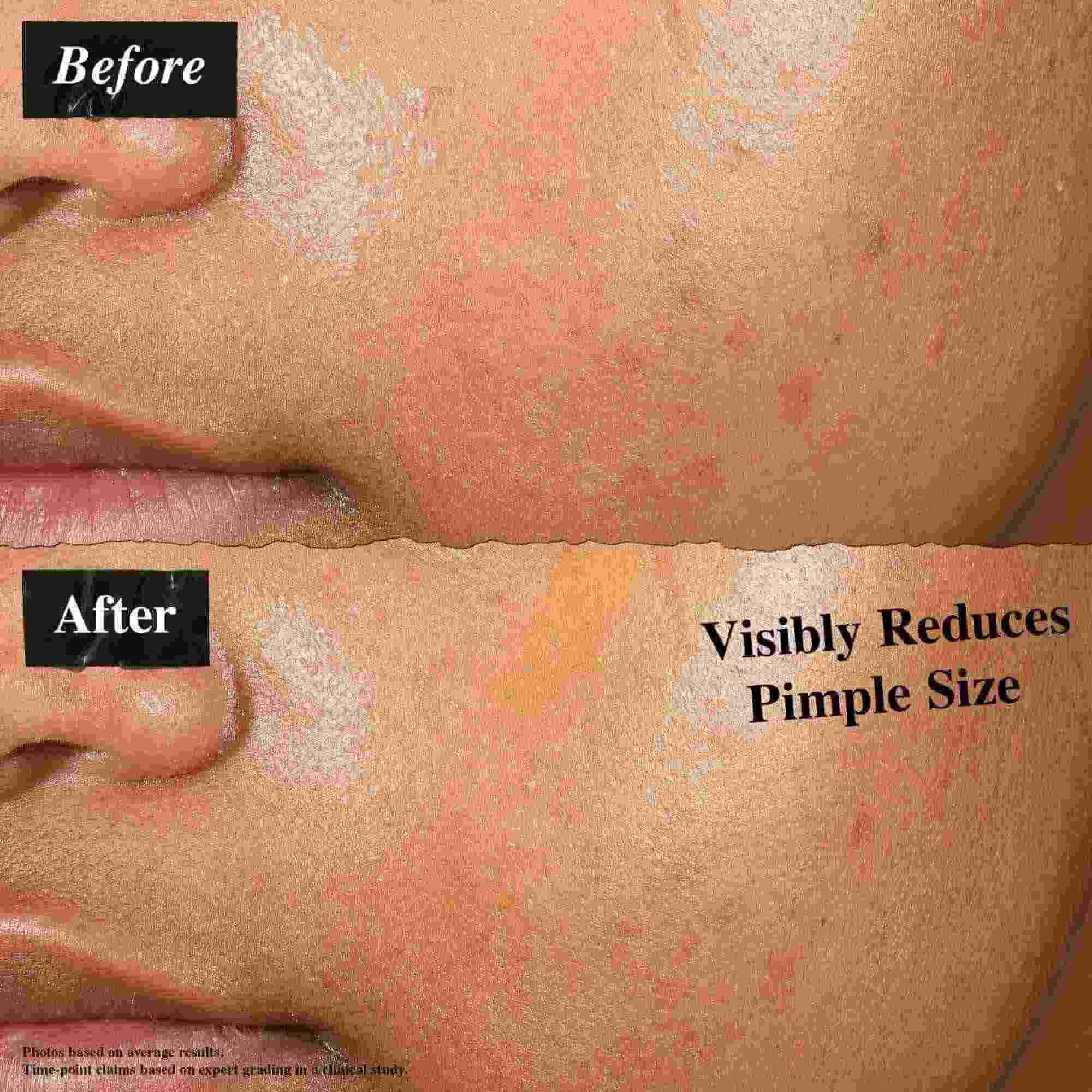 Srovnani před a po ukazujici pleť ošetřenou Truly-Targeted Blemish-Clearing Solution. Obrazek "před" ukazuje viditelne pupinky, zatimco obrazek "po" ukazuje zmenšenou velikost pupinků.