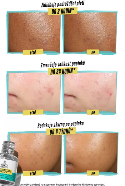 Alt text: A comparison image showing the effects of a skincare product on acne. The top two panels show before and after results of reduced pimple color in 2 hours, with noticeable color improvement. The middle panels depict before and after results of reduced pimple size in 24 hours, showing smaller pimples after treatment. The bottom panels illustrate before