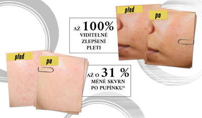 Comparison image showing before and after results of acne treatment. The "before" photos display skin with blemishes, while the "after" photos show clearer skin, highlighting 100% of users experienced acne clearing and a 31% reduction in post-blemish marks.