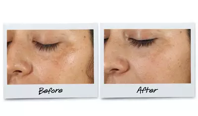 Before and after images of a woman's face, focusing on her skin texture and appearance around the eyes. The "Before" image shows uneven skin tone and some blemishes, while the "After" image displays smoother, clearer skin.
