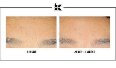 Vysledky po použivani Retinol Skin-Renewing Daily Micro-Dose Serum